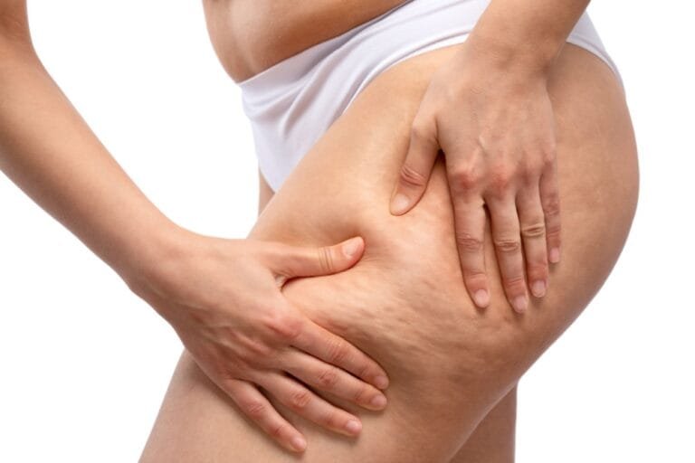 Lipoaspiração para o tratamento de lipedema