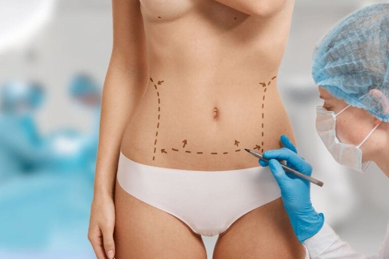 Como funciona a recuperação da lipoabdominoplastia MILA?