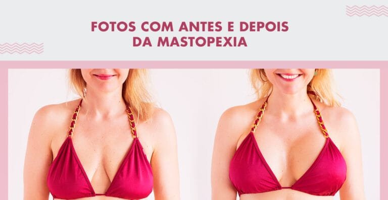 Mastopexia Antes e Depois: fotos e dicas para você ter o resultado dos seus sonhos!
