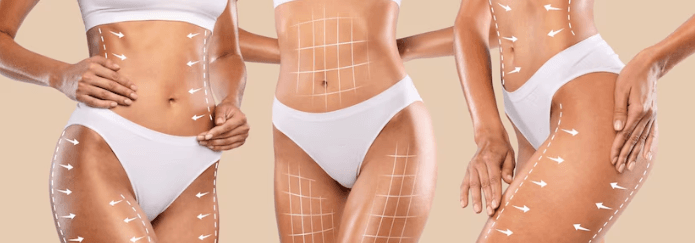 Quais áreas do corpo são tratadas com a lipoabdominoplastia MILA?