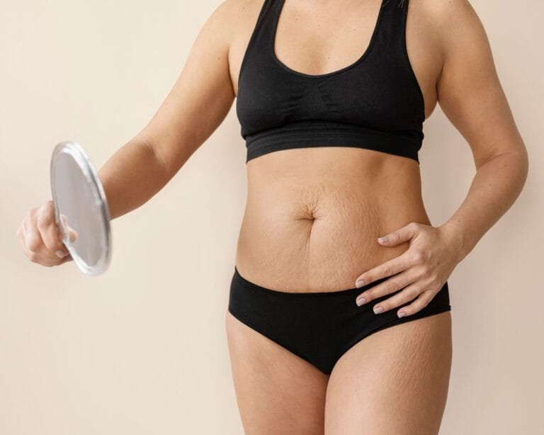 Benefícios da lipoabdominoplastia minimamente invasiva MILA