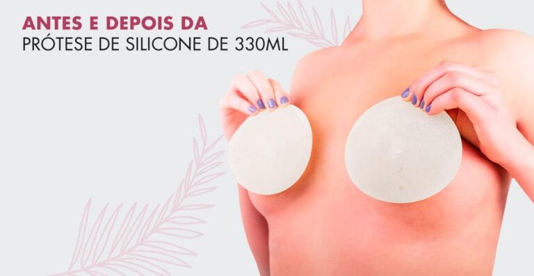 Silicone 325 ml ou 330ml? Confira fotos de antes e depois e dicas para escolher o tamanho certo da sua prótese!